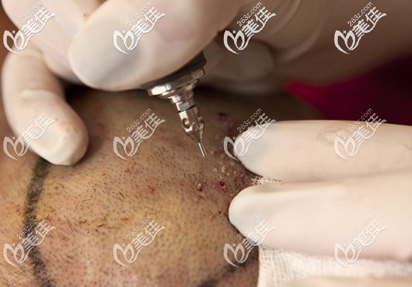 頭頂發(fā)旋稀疏加密手術(shù) 頭頂發(fā)旋稀疏加密手術(shù)