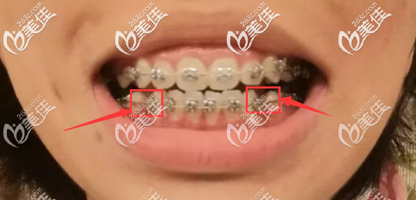 北京維樂(lè)口腔戴金屬自鎖托槽矯正器 北京維樂(lè)口腔戴金屬自鎖托槽矯正器