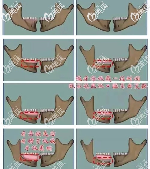 長(zhǎng)期戴活動(dòng)假牙的牙槽骨變化圖