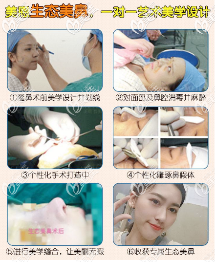 廣東美恩張勇院長(zhǎng)隆鼻手術(shù)過(guò)程案例圖片