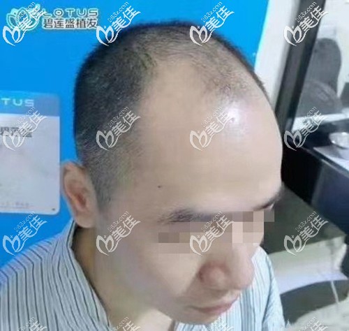 前額M型發(fā)際線脫發(fā) 前額M型發(fā)際線脫發(fā)