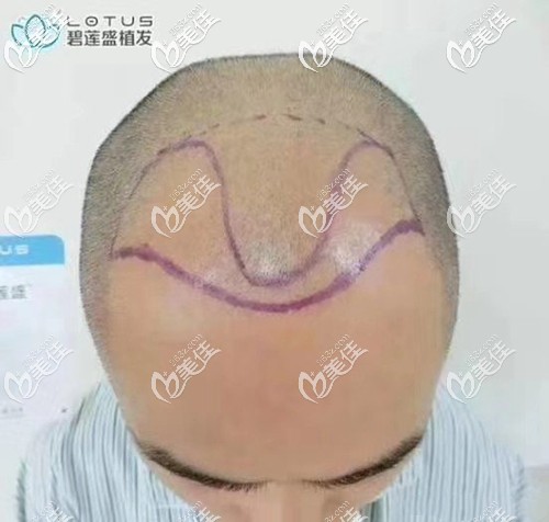 術(shù)前設(shè)計(jì)發(fā)際線種植方案 術(shù)前設(shè)計(jì)發(fā)際線種植方案