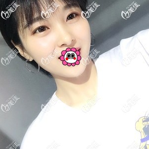 花三萬多做了自體肋軟骨隆鼻一點(diǎn)都不后悔，分享一下我恢復(fù)三個月的經(jīng)歷