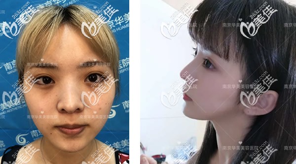 南京華美曹海峰鼻子案例