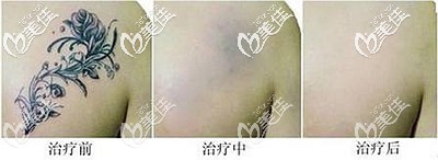 皮秒洗紋身五次后的效果