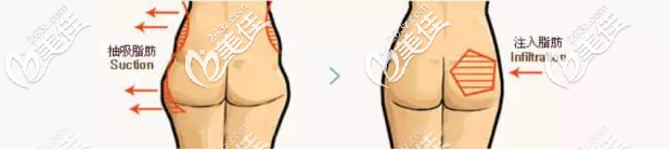 自體脂肪豐臀 自體脂肪豐臀