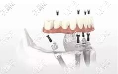 all-on-4微創(chuàng)即刻種植牙 all-on-4微創(chuàng)即刻種植牙