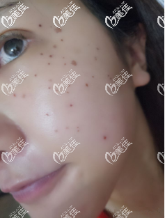 術(shù)后2天結(jié)痂了 術(shù)后2天結(jié)痂了