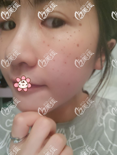 希望斑點(diǎn)快點(diǎn)下去 希望斑點(diǎn)快點(diǎn)下去