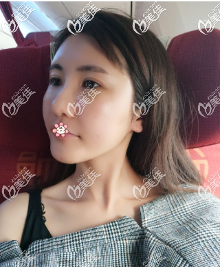 我在重慶時(shí)光整形做完皮秒祛斑一個(gè)月了 我在重慶時(shí)光整形做完皮秒祛斑一個(gè)月了