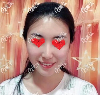 玻尿酸填充面部術(shù)后3天效果圖