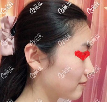 注射玻尿酸填充面部術(shù)后半個月效果圖