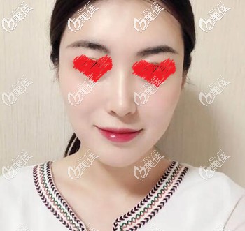 額頭扁平有淚溝的我找遼寧曙光劉春曉做了玻尿酸填充后效果真心不錯，一共打了10ml！