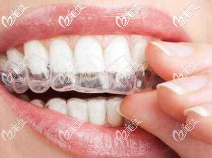 隱形牙套