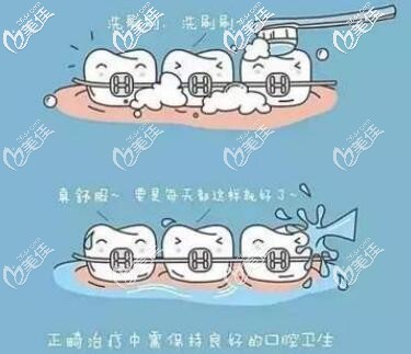 正畸保持口腔衛(wèi)生