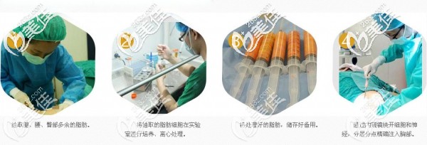 自體脂肪隆胸過程示意圖