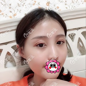 雙眼皮術后恢復一個月效果自然