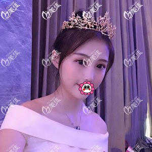 看到有人咨詢寧波美萊哪個醫(yī)生做眼睛好，分享我找姚遠做雙眼皮案例作參考吧