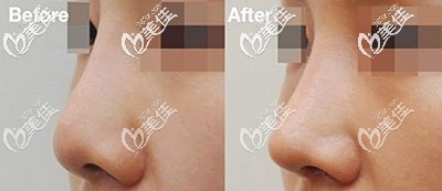 曼特波假體隆鼻后的效果對(duì)比 曼特波假體隆鼻后的效果對(duì)比