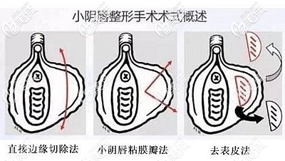 小陰唇縮小手術(shù)的方法