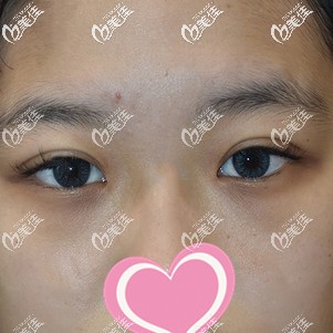 都說腫眼泡不適合做定點(diǎn)雙眼皮，但我找日本Noel銀座整形的保志院長做后效果很自然