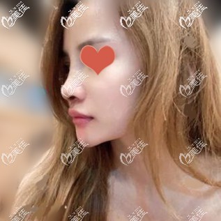 在泰國做鼻修復(fù)術(shù)后一周照