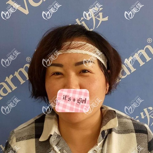 種植眉毛術后即刻效果