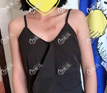 假體隆胸術(shù)前圖片 假體隆胸術(shù)前圖片