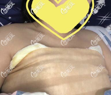 假體隆胸術(shù)后3天樣子 假體隆胸術(shù)后3天樣子