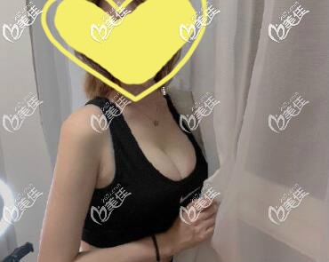 做曼托水滴235cc假體隆胸一個(gè)月療效圖片 做曼托水滴235cc假體隆胸一個(gè)月療效圖片