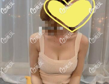 我做曼托235cc水滴假體隆胸真實講述:1個月胸假體不再移位,3個月后平躺胸也是軟的!