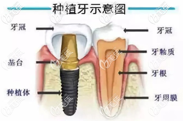 種植牙的結(jié)構(gòu)示意圖 種植牙的結(jié)構(gòu)示意圖