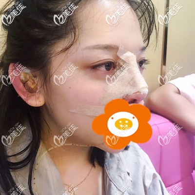 剛做完手術(shù)的丑樣