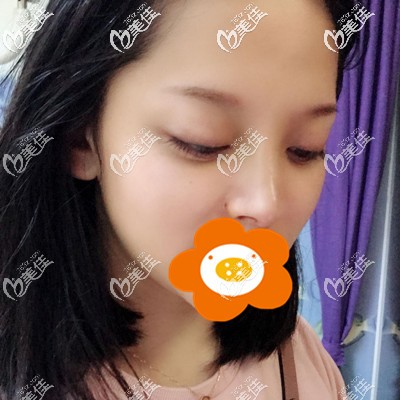 做完隆鼻手術(shù)后一周