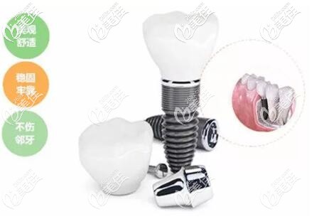 種植牙優(yōu)勢(shì)