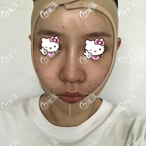 面部吸脂術后即刻戴著彈力面罩 面部吸脂術后即刻戴著彈力面罩