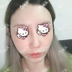 剛卸掉彈力面罩的手術效果 剛卸掉彈力面罩的手術效果