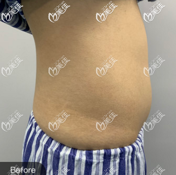 在青島諾美德做腰腹吸脂手術(shù)前的樣子 在青島諾美德做腰腹吸脂手術(shù)前的樣子