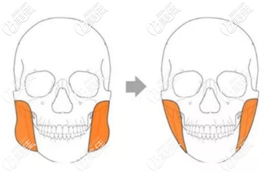 切除咬肌的手術(shù)方法