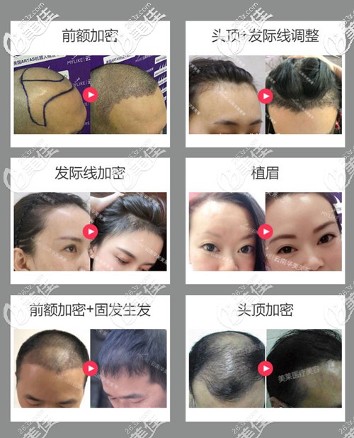 <!--<i data=20240703-sp></i>-->美萊俞滿昌植發(fā)案例 <!--<i data=20240703-sp></i>-->美萊俞滿昌植發(fā)案例