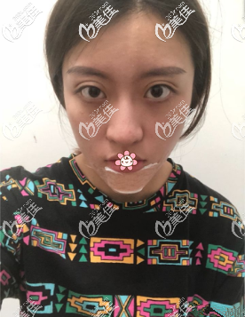 在遵義韓美做完硅膠墊下巴剛一周 在遵義韓美做完硅膠墊下巴剛一周