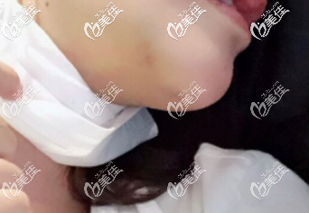 拆完線了 拆完線了