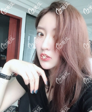 去遵義這家醫(yī)院前挺害怕做硅膠墊下巴會疼會歪會有后遺癥的，結(jié)果連我也驚訝