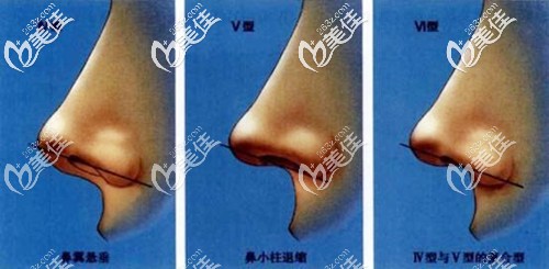 鼻小柱下垂的幾種情況