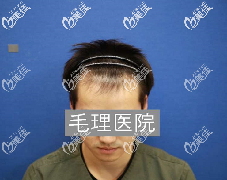 植發(fā)術(shù)前