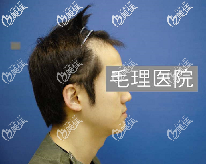 植發(fā)前側(cè)拍發(fā)際線