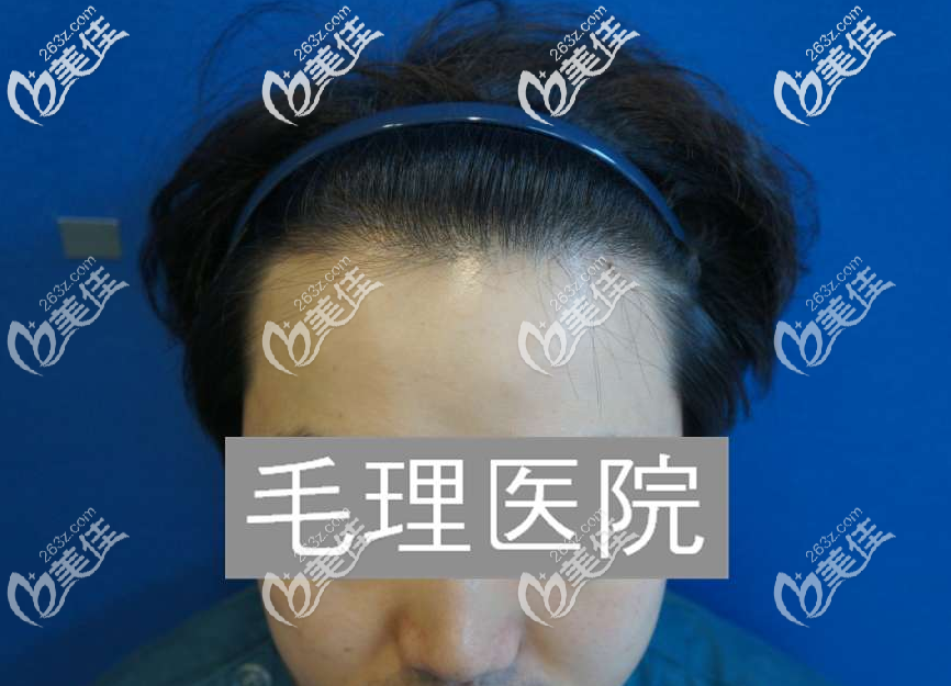 植發(fā)后一年效果