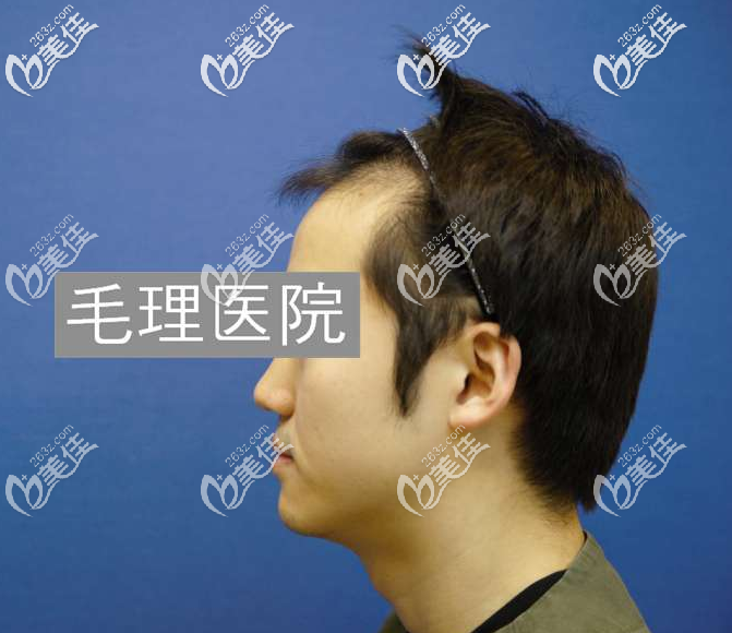 毛理醫(yī)院植發(fā)