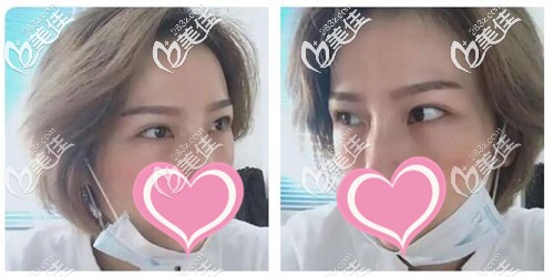 外切祛眼袋手術(shù)后7天照片 外切祛眼袋手術(shù)后7天照片