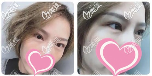 外切去眼袋手術(shù)半個(gè)月 外切去眼袋手術(shù)半個(gè)月